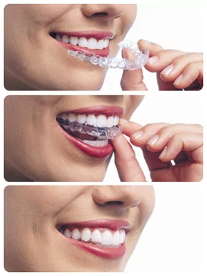 get straight teeth with orthodontics in Montecito and Santa Barbara